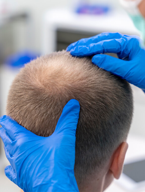 Fue Hair Transplant Turkey